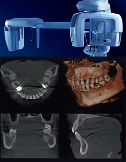 歯科用CT