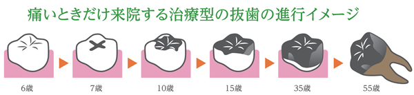 抜歯の進行イメージ