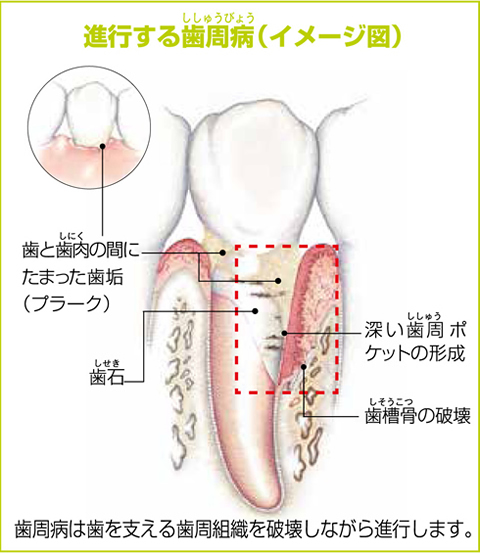 歯周病が進行すると？