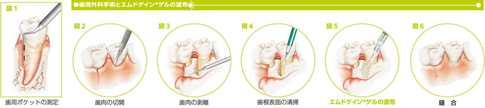 エムドゲインゲルを使った治療方法について