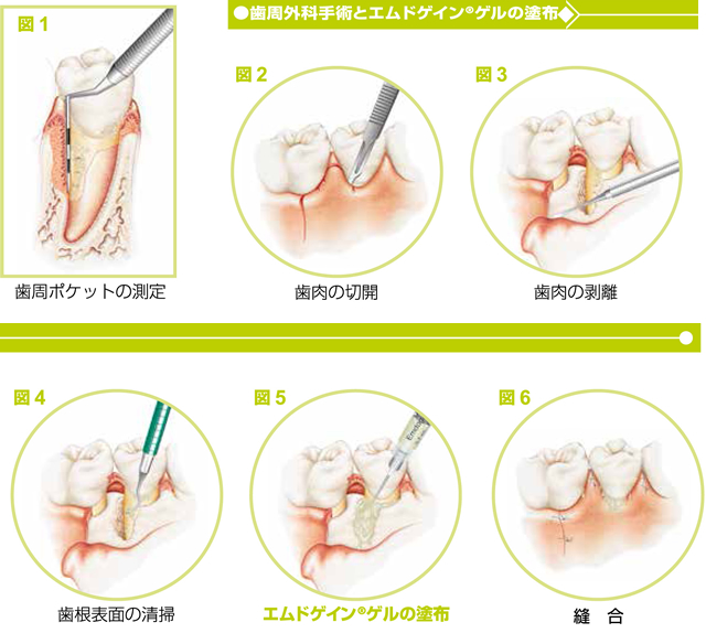 エムドゲインゲルを使った治療方法について