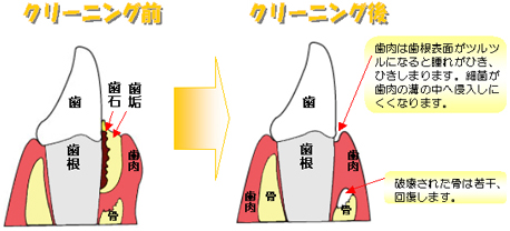 ブラッシング指導